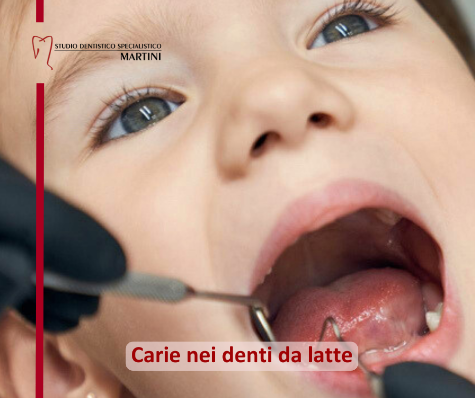Carie nei denti da latte