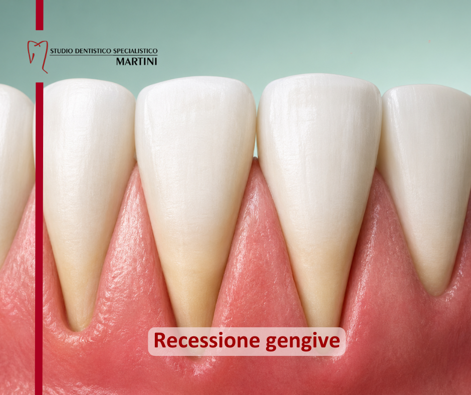 Gengive in recessione nei giovani: cause e trattamenti