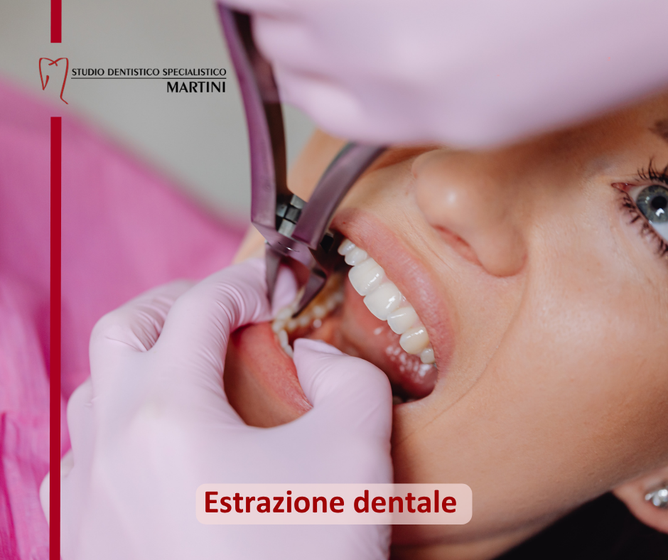 Cosa aspettarsi dopo un’estrazione dentale