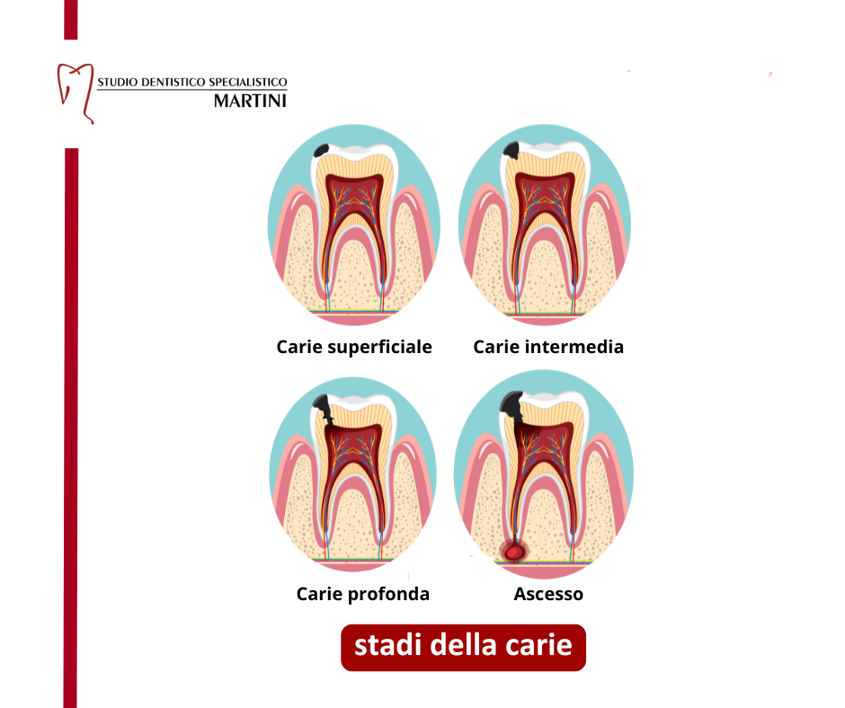 Carie dentale: i diversi stadi